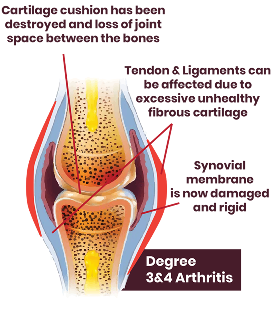 3-4 degrees of arthritis