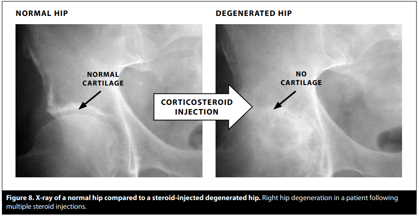 normal-steroid damaged hip