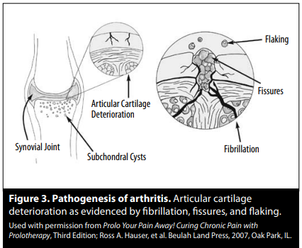 pathogenesis of arthritis