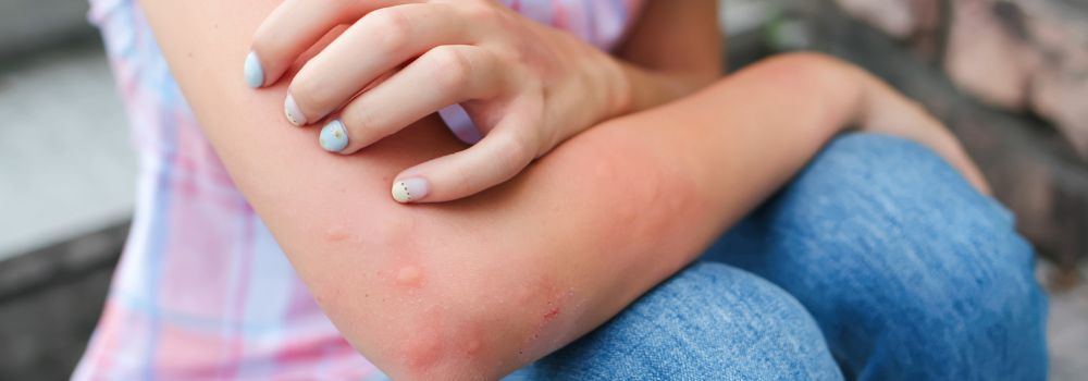 Stress suppresses your immune system and produces rashes, hives, and redness