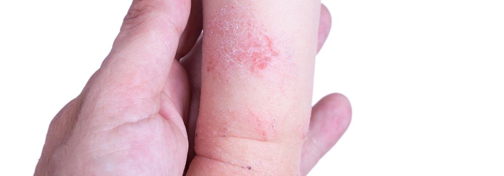 discoloration due to eczema - kandyway
