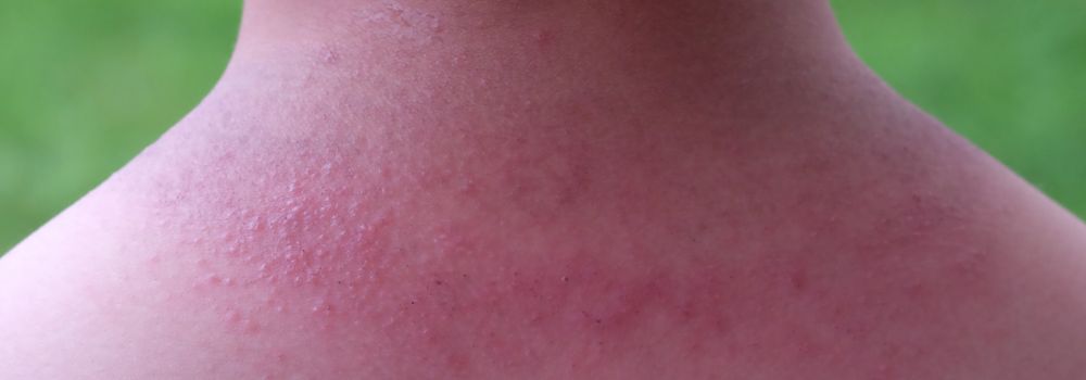 discoloration due to heat rash - kandyway