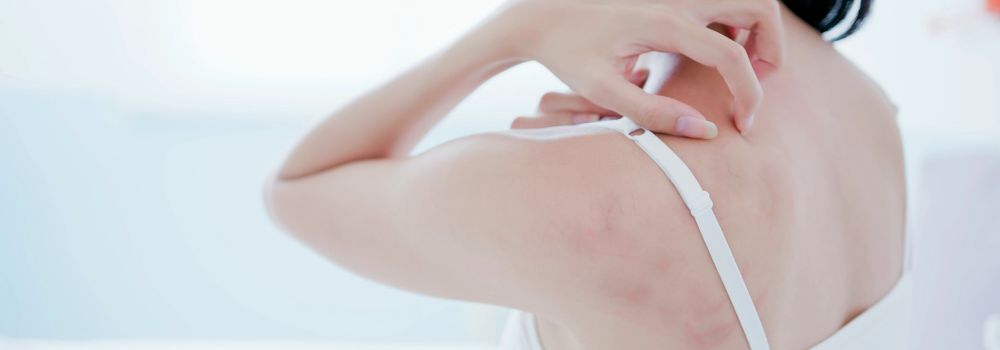 people with eczema and psoriasis should take extra care of their skin while stressed