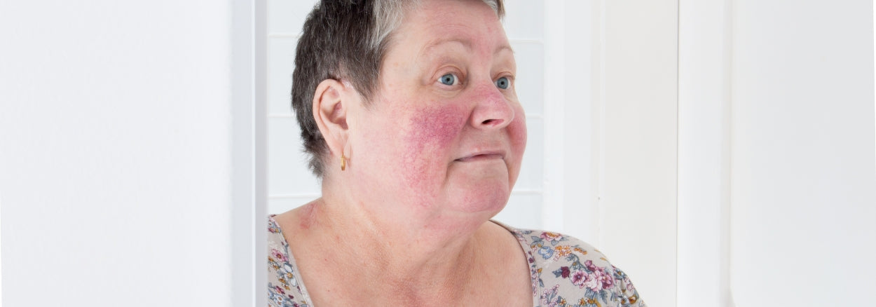 rosacea skin problem to middle aged woman