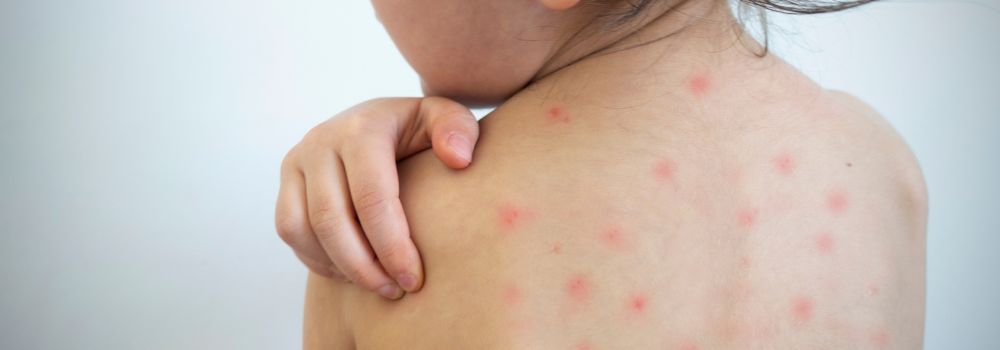 skin discoloration caused by chickenpox - kandyway