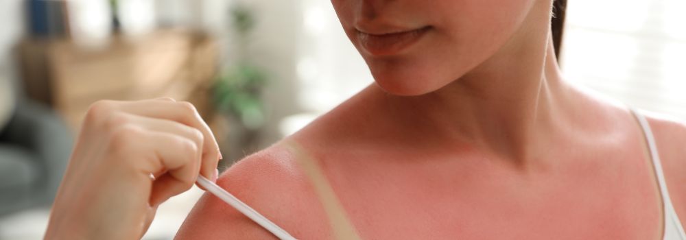skin discoloration caused by sunburn - kandyway