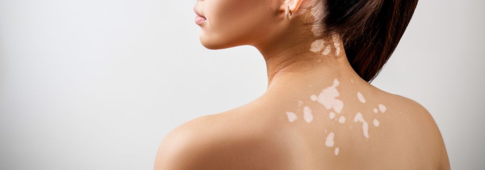 vitiligo une affection cutanée hypopigmentation - kandyway