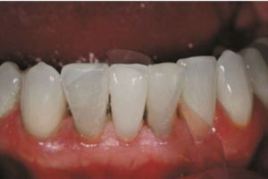 Use of Ho Dental Mylar Matrix Roll in situ