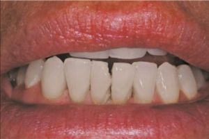 Restore Mandibular Teeth - Pre-Treatment