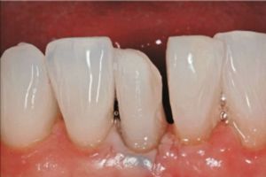 Restore mandibular teeth - Fig 2