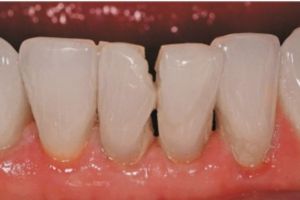 Restore Mandibular Teeth - Fig 3