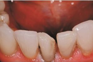Restore Mandibular Teeth - Fig 4