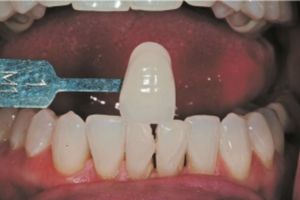 Restore Mandibular Teeth - Fig 5