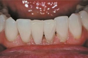 Restoration of Manibular Teeth 