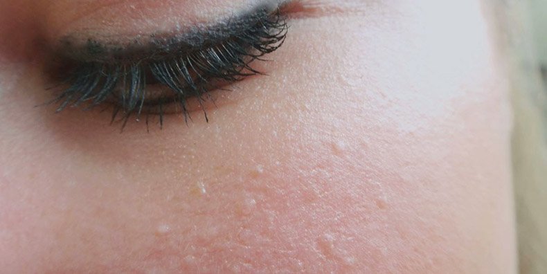 white bumps on chest