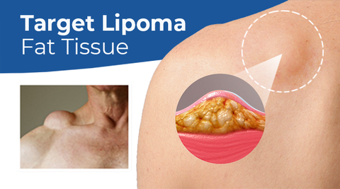 MEDix™ Lipoma Removal Cream