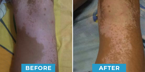 MEDix™ Vitiligo Treatment Cream