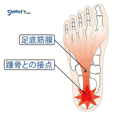 足底筋膜炎、足底腱膜炎の原因