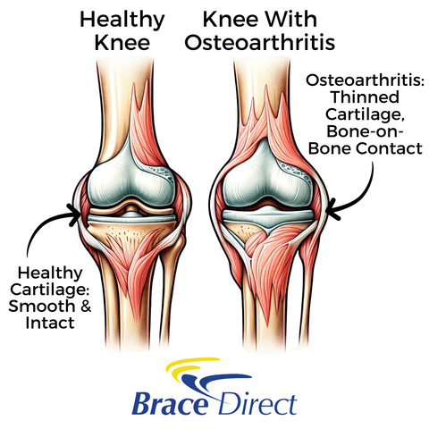 Healthy Knee - Osteoarthritis Impact