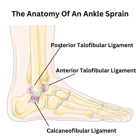 What is an ankle sprain in a child look like?