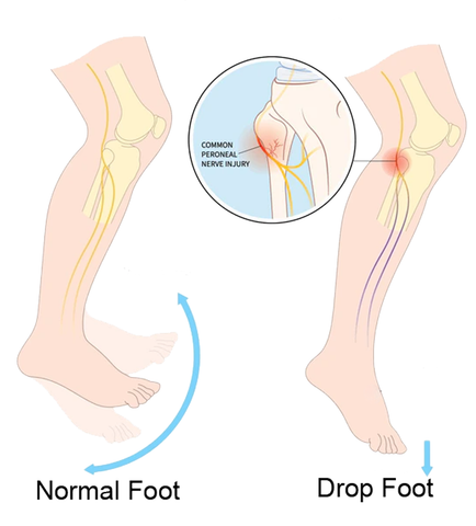 What is Drop Foot? A medical diagram by Brace Direct