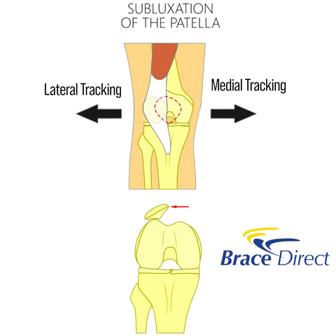 The difference in lateral and medial patellar subluxation.