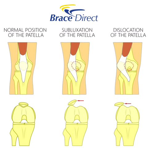 The difference in a normal patella, a patellar subluxation, and a patellar dislocation.