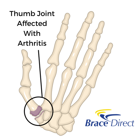 Arthritis of the Thumb