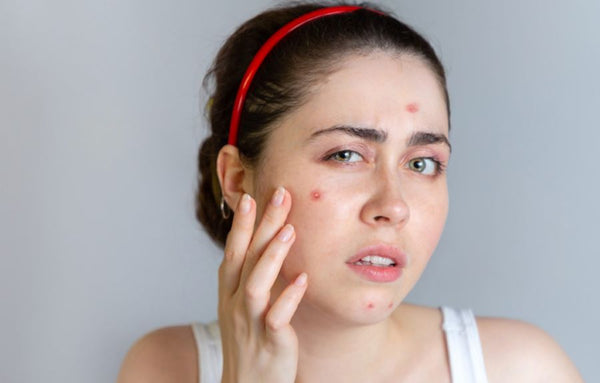 Rimedi naturali acne ormonale