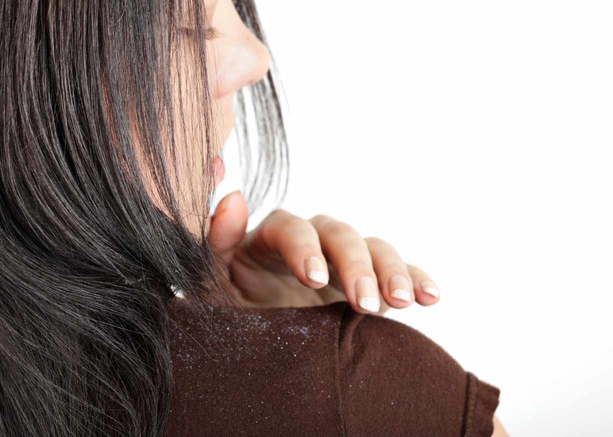 dandruff flakes on shirt