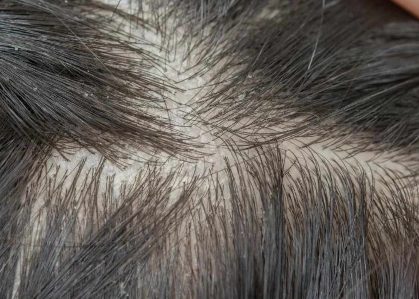 dry scalp vs dandruff comparison