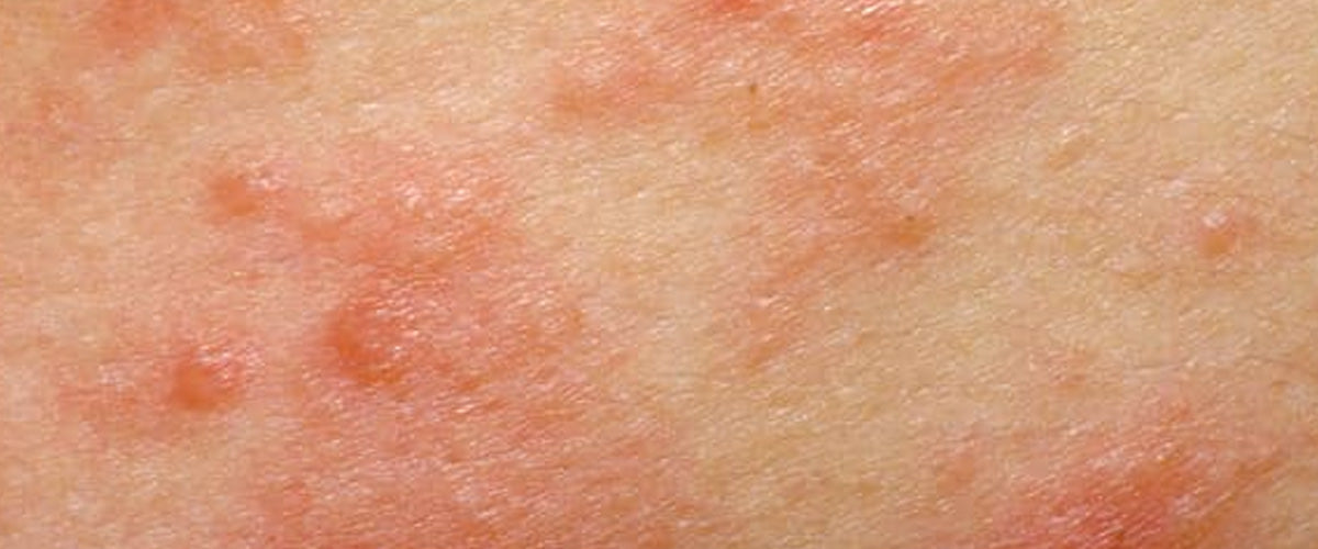 Sensitive-Skin-with-Eczema