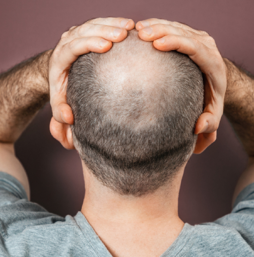 Balding at Scalp