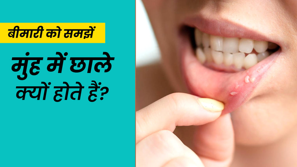 Types of Mouth Ulcers in Hindi