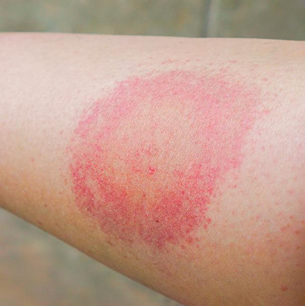 bệnh lyme