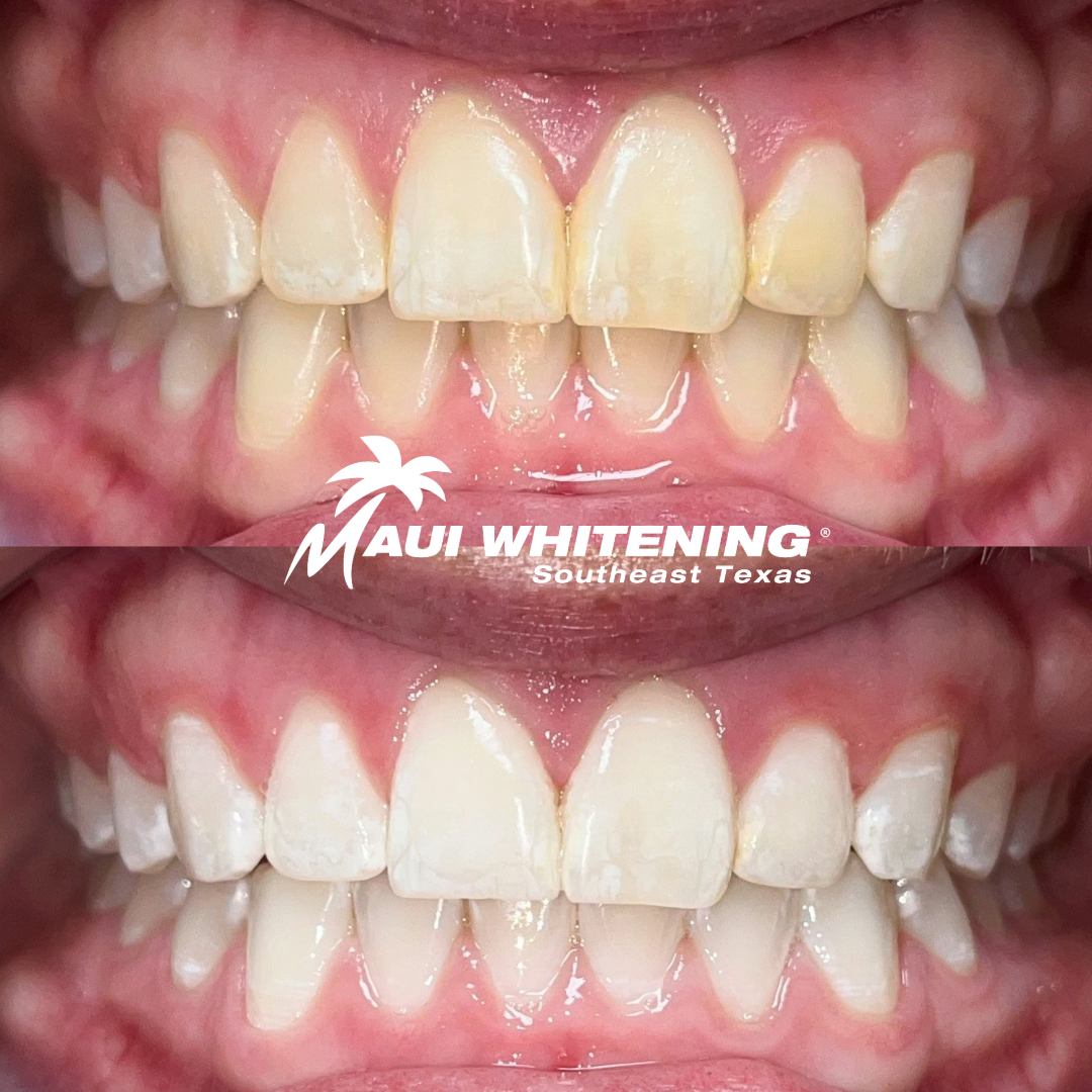 Maui Whitening SETX | Orange County | Laser Teeth Whitening