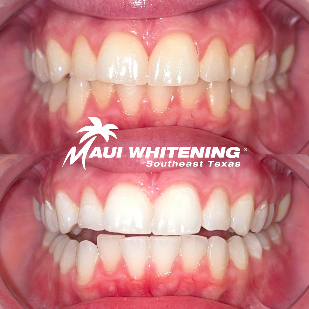 Maui Whitening SETX | Orange County | Laser Teeth Whitening