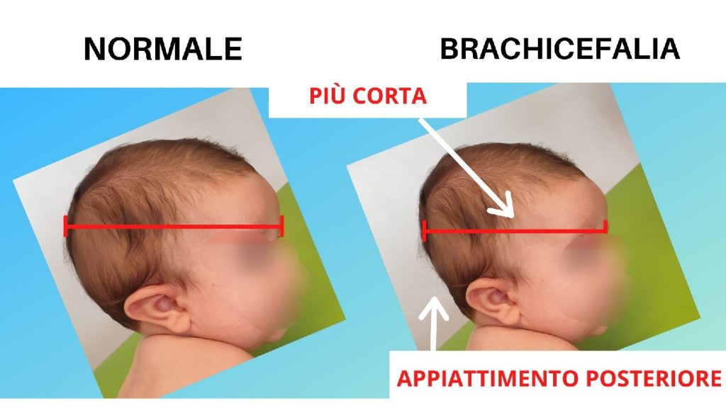 Cuscino Anti Reflusso per neonati – I FUORIMISURA