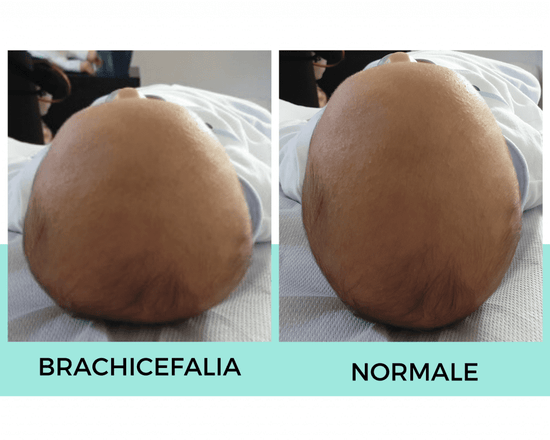 Brachicefalia neonato: cos’è, come riconoscerla e come intervenire Dr-Silva