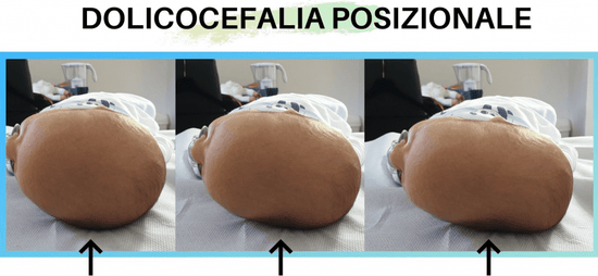 dolicocefalia posizionale