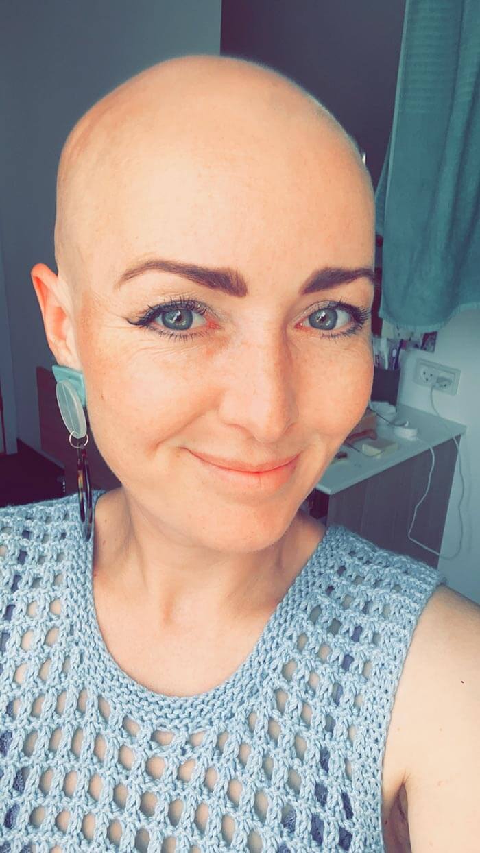 Kvinde der lider af hårtabssygdommen alopecia