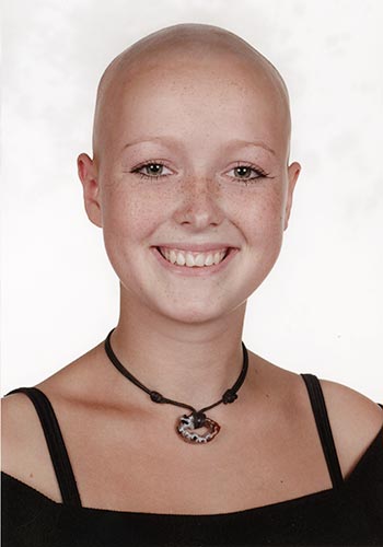 Aja med alopecia