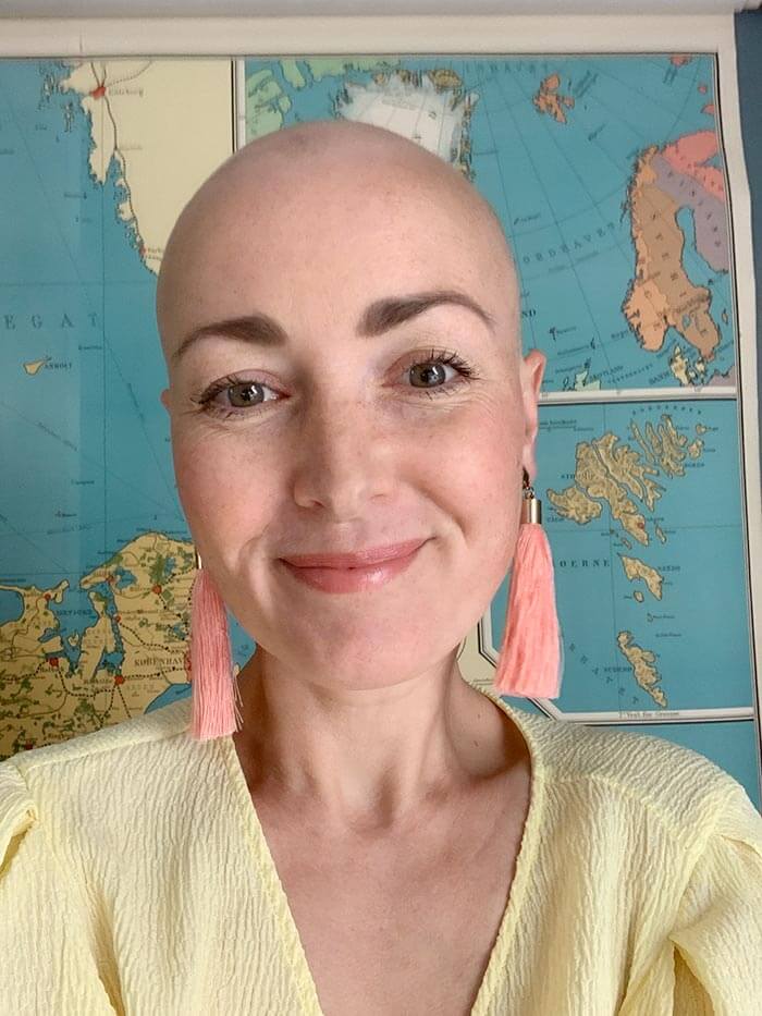 Aja med alopecia uden hår