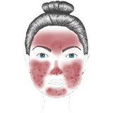 rosacea utslag