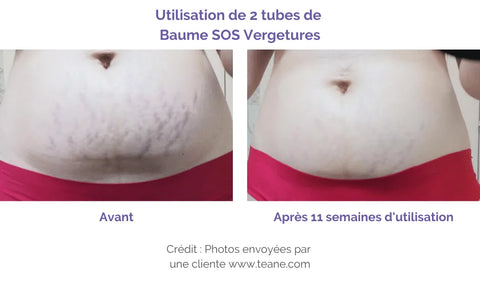 Grossesse : comment prendre soin de ses vergetures ?