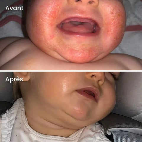 before after eczema