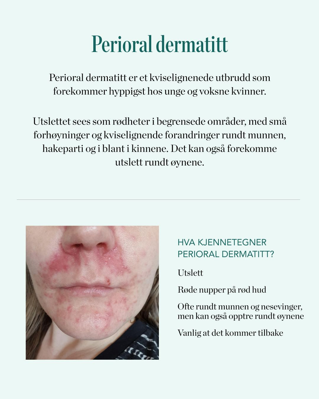 redningen for perioral dermatitt - elixir sos paste