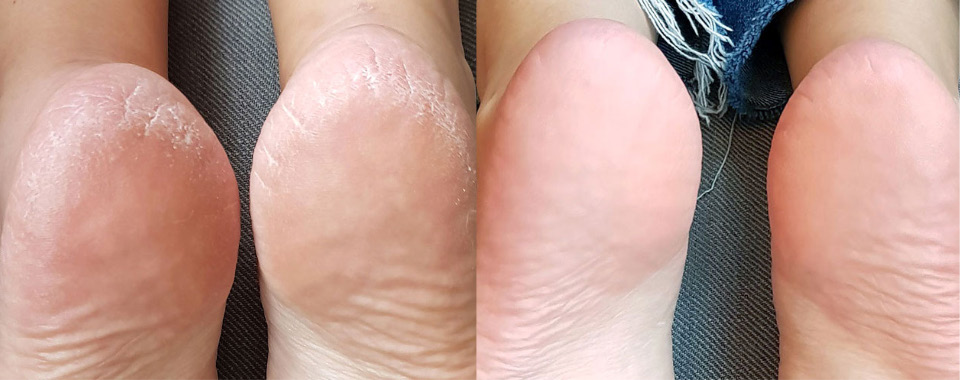 Lova Skin Instant Foot Peeling før og etter bildet