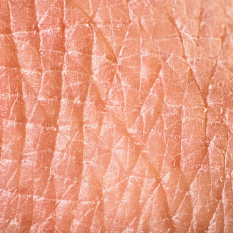 Dry skin can cause Inflammaging and impaired skin barrier health