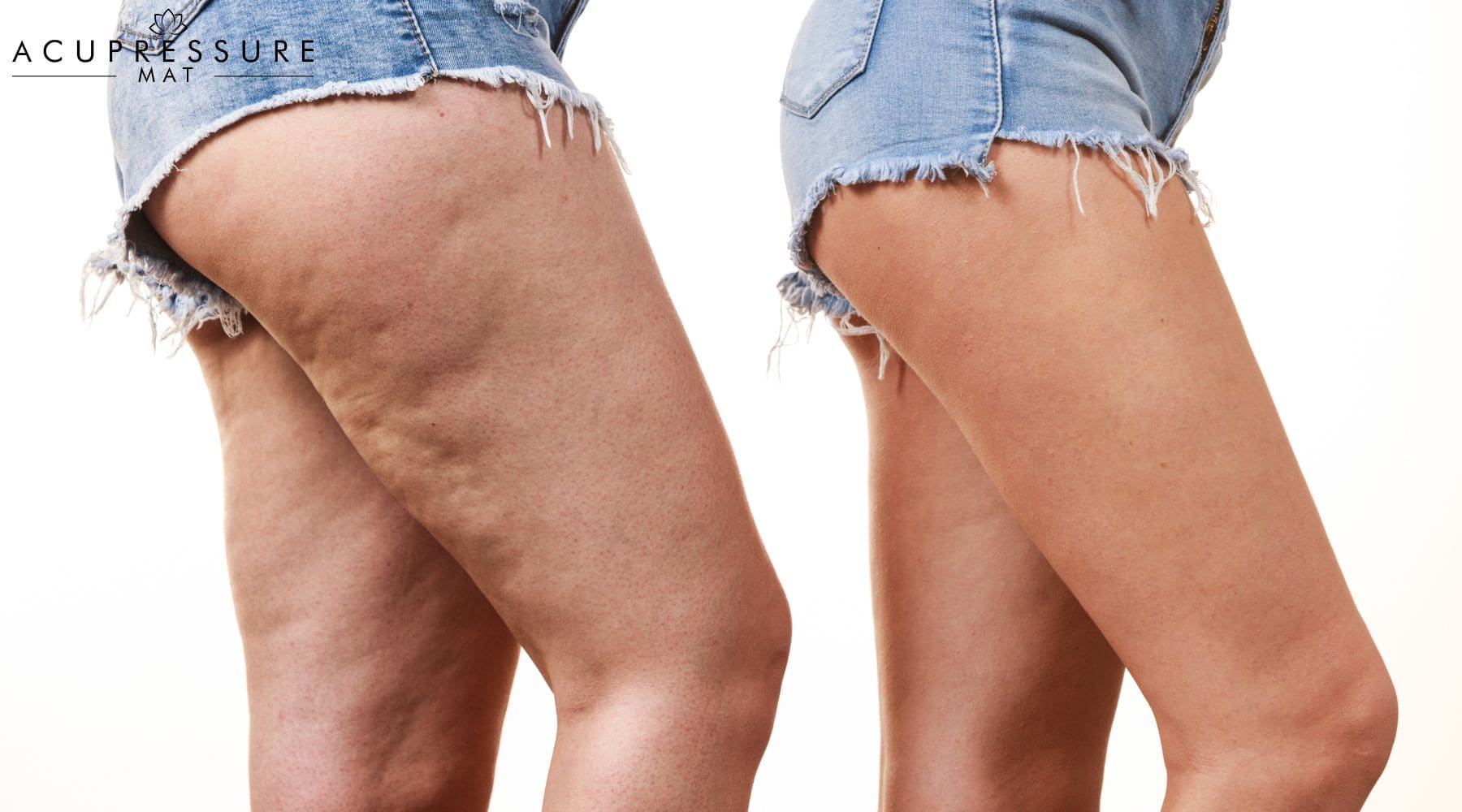 cellulite